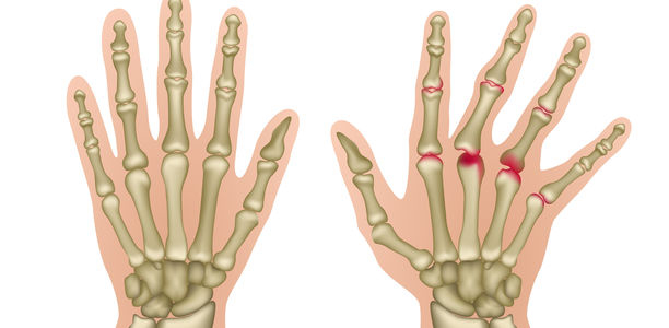 Bild zu Rheumatoide Arthritis - Frühe Diagnose rettet Knochen
