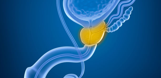 Bild zu Prostata - Weniger Prostatektomien