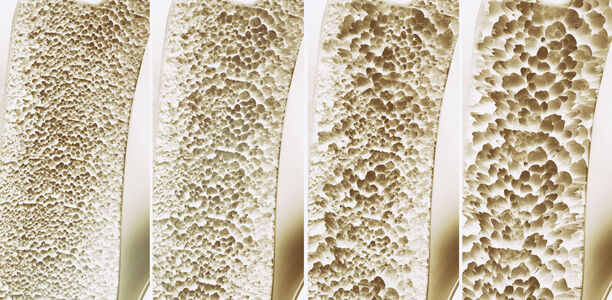 Bild zu Osteoporose - Vitamin D beeinflusst Knochendichte kaum