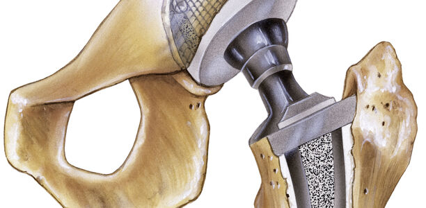 Bild zu Hüftgelenksersatz - Welche Prothese für welchen Patienten?