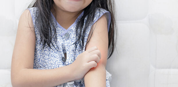Bild zu Atopische Dermatitis - Was braucht die gequälte Kinderhaut? 