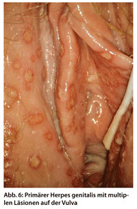 Vagina der herpes an Herpes genitalis.