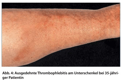 Was ist eine oberflächliche thrombophlebitis