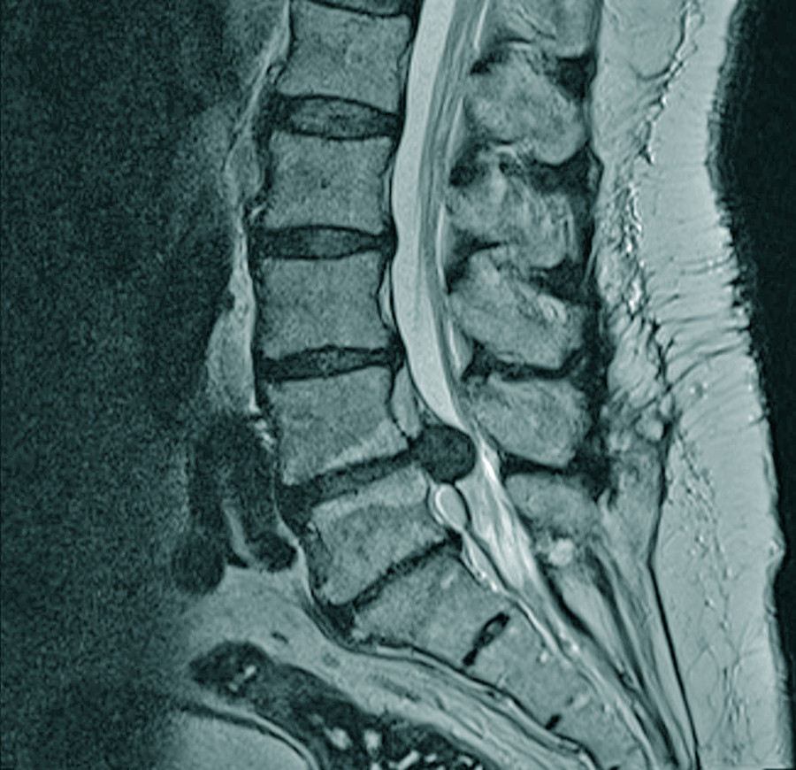 Rückenschmerzen - Wann muss operiert werden? • doctors|today