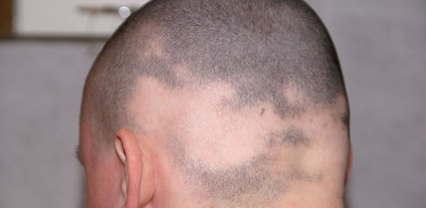 Bild zu Haarausfall - Was ist krankhaft, was normal?