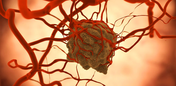 Bild zu Tumornachsorge - Cave: Sekundärneoplasien