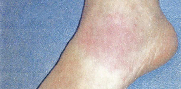 Bild zu Hautrötung am Fuß - Was kann es sein?