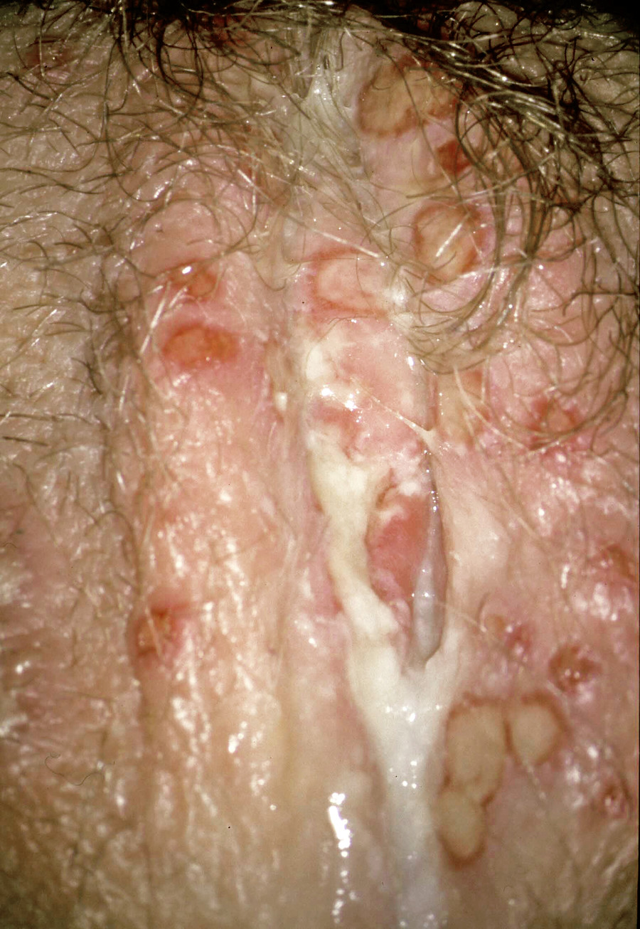 Herpes genitalis frau