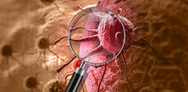 Bild zu Krebsmedikamente - Auf Kardiotoxizität achten!