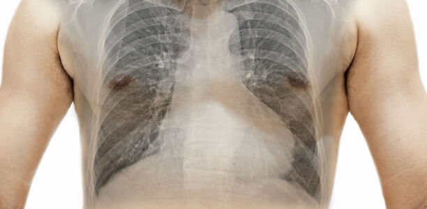 Bild zu Asthma und COPD - Wann kommen ICS zum Zug?