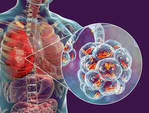 Bild zu Häufige Lungen- und Atemwegsinfektionen - Diagnostik in Pandemiezeiten