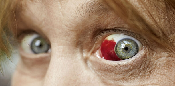 Bild zu Trockenes Auge und saisonale allergische Konjunktivitis - Bei Augenproblemen genau hinsehen   