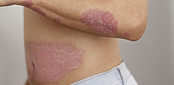 Bild zu Psoriasis & Co - Hautkrankheiten in der Pandemie