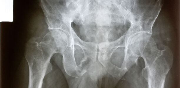 Bild zu Palliativmedizinische Behandlung von Knochenmetastasen - Wenn jeder Schritt schmerzt