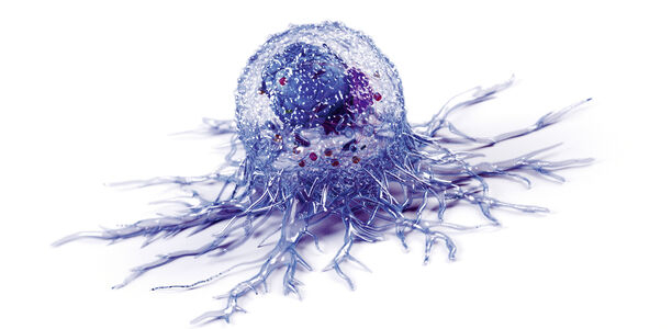 Bild zu Onkologische Tumoren - Schmerzen lindern mit System