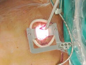 Bild zu Video 1 - Operative Versorgung einer Aortenklappenstenose (SAVR)