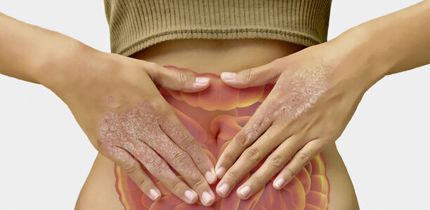 Bild zu Schuppenflechte - Kranker Darm macht Psoriasis
