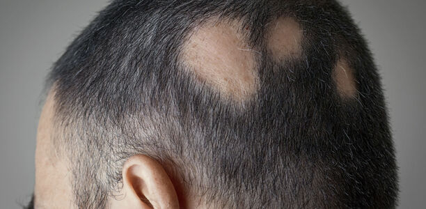 Bild zu JAK-Inhibitoren und mehr - Haarausfall: neue Therapien