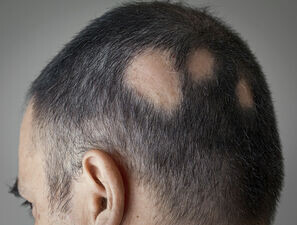 Bild zu JAK-Inhibitoren und mehr - Haarausfall: neue Therapien